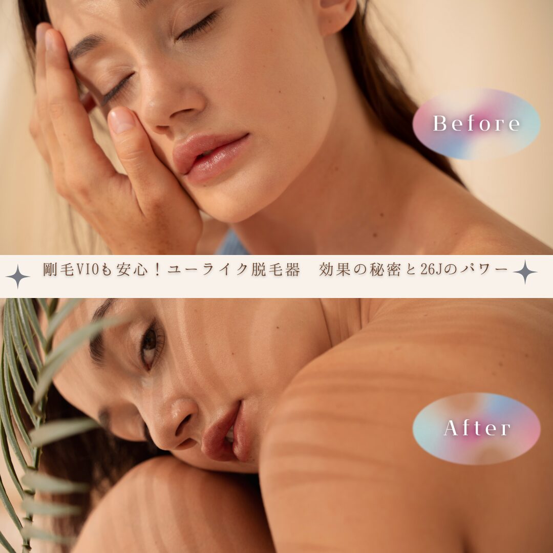 剛毛VIOも安心!ユーライク脱毛器 効果の秘密と26Jのパワー