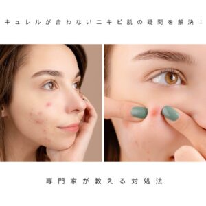 キュレルが合わないニキビ
